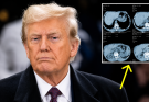Internet On Edge After Trump Reveals The Results Of His MRI Scan..